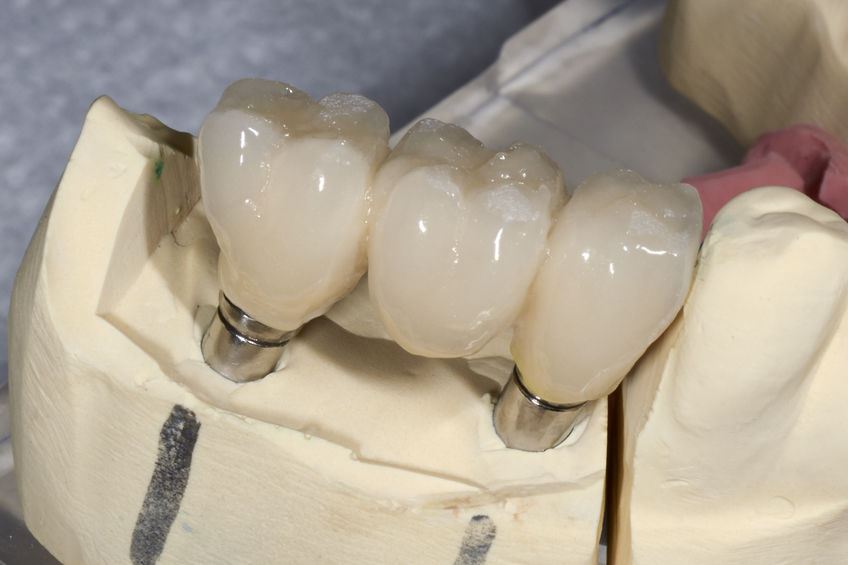 Dental implant to three elements