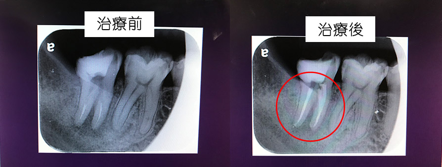 endo endo